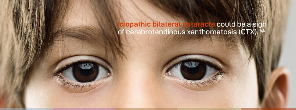 Idiopathic bilateral cataracts could be a sign of cerebrotendinous xanthomatosis (CTX).